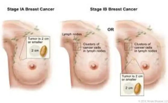 The Growth Rates and Tumor sizes of Breast Cancer