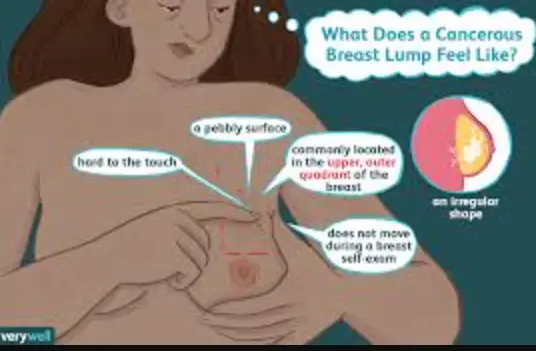 Where you can find Breast Cancer Lumps in the body