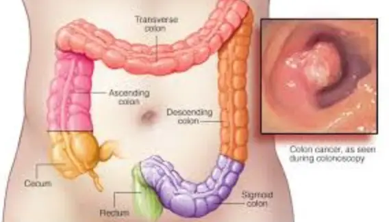 All you should know about Colon and Rectal Cancer