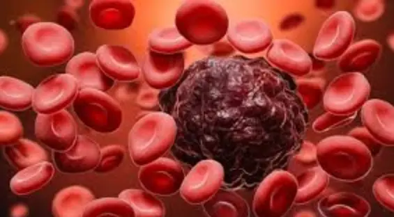 All you should know about Leukemia