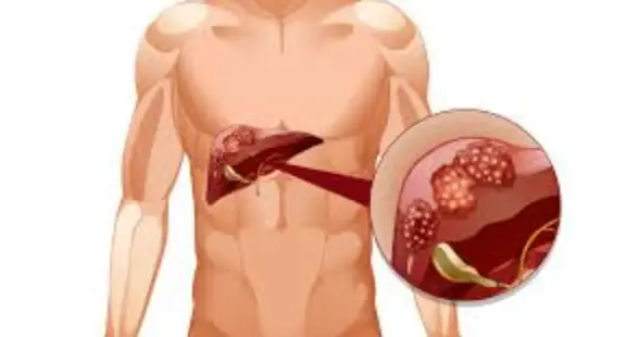 All you should know about Liver Cancer
