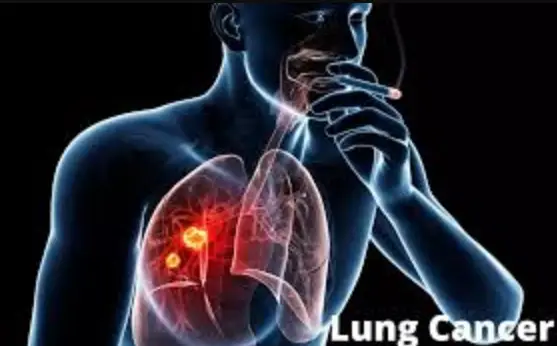 All you should know about Lung Cancer