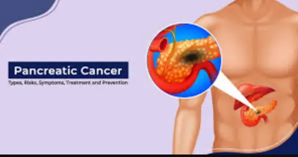 All you should know about Pancreatic Cancer