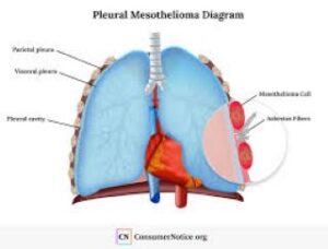 Causes and Risk Factors of Mesothelioma and Lung Cancer