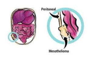 Causes of Peritoneal Mesothelioma