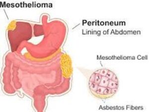 Understanding Peritoneal Mesothelioma